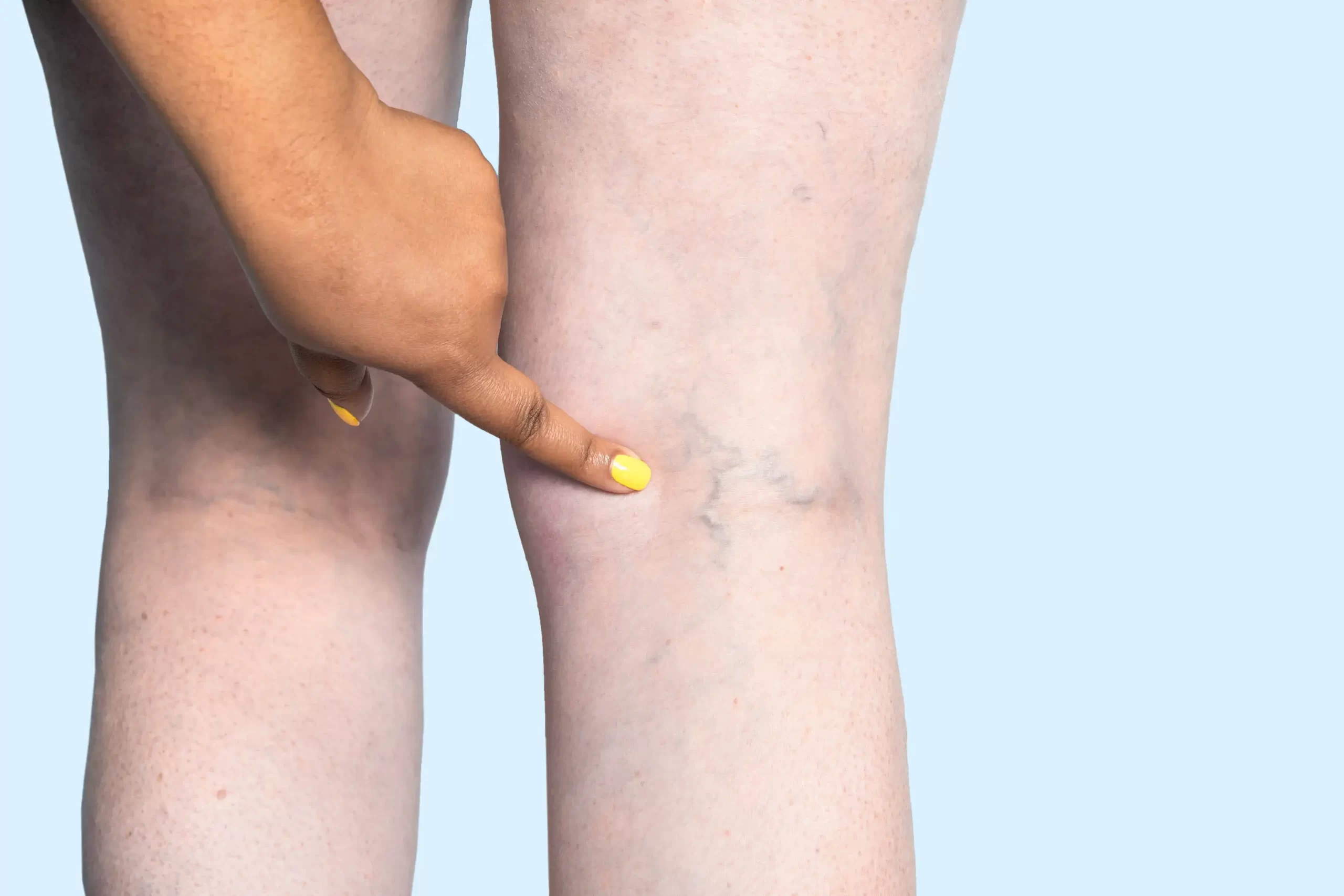what-is-chronic-venous-insufficiency-q80